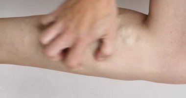 Bacağı varis damarlarıyla kaşınıyor. Yüksek kalite 4k görüntü