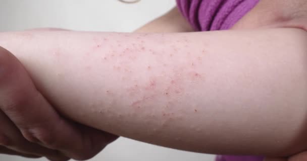 赤いアレルギー性発疹皮膚炎赤ちゃんの手を閉じてください 高品質4K映像 — ストック動画