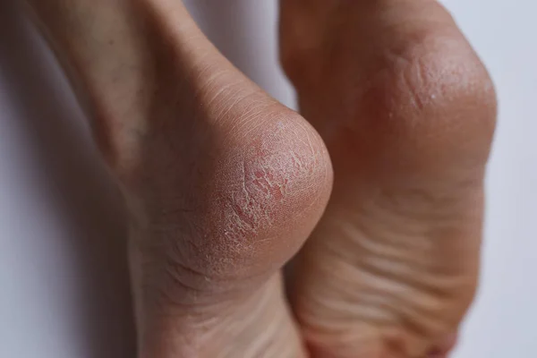 Pés femininos secos, calcanhar rachado requer cuidados com a pele spa — Fotografia de Stock