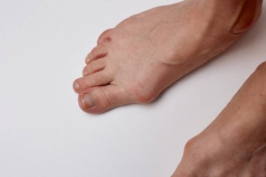 Kızın bacağındaki hallux valgus deformasyonu tedavi gerektirir..