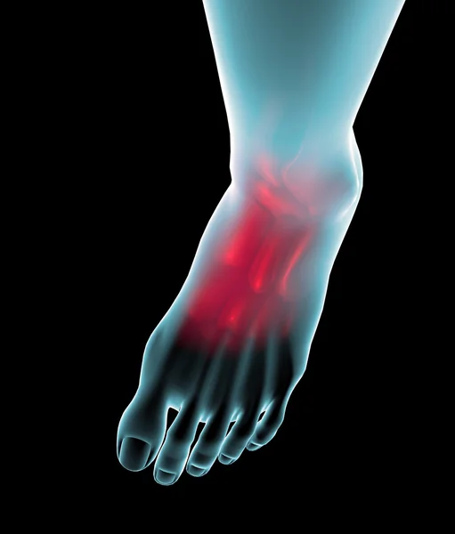 Foot seen on x-ray with pain — Stock Photo, Image