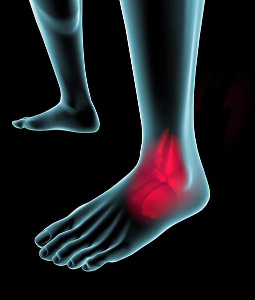 Fuß mit Schmerzen auf Röntgenbild gesehen — Stockfoto