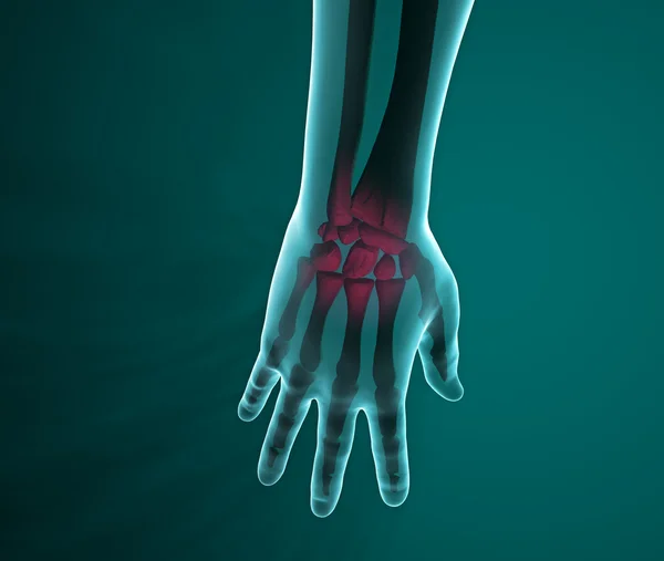 X-ray of a hand and wrist pain — Stock Photo, Image