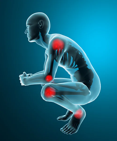 人間の関節痛の x 線 — ストック写真