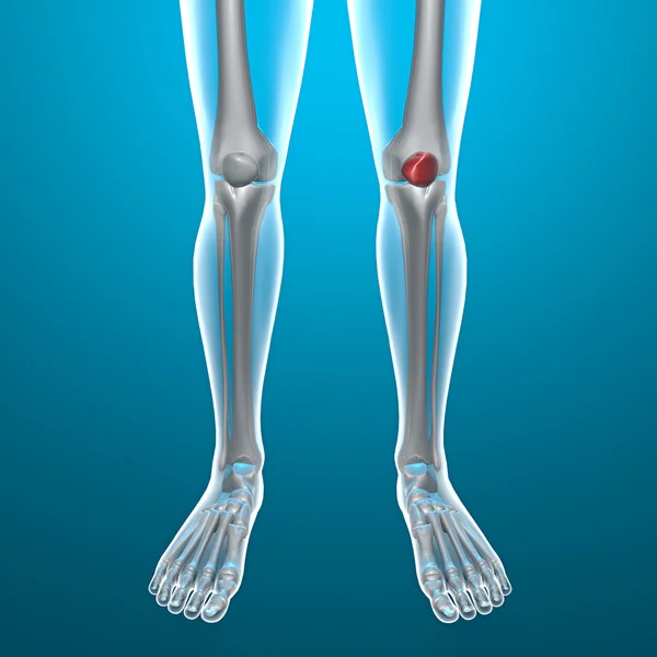 人类的腿的 x 光影像 — 图库照片