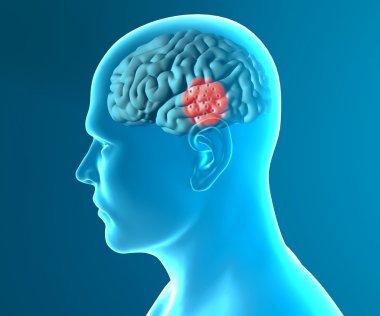 Brain degenerative diseases, Parkinson clipart