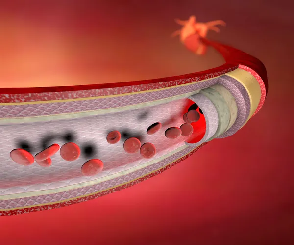 Coronary artery — Stock Photo, Image