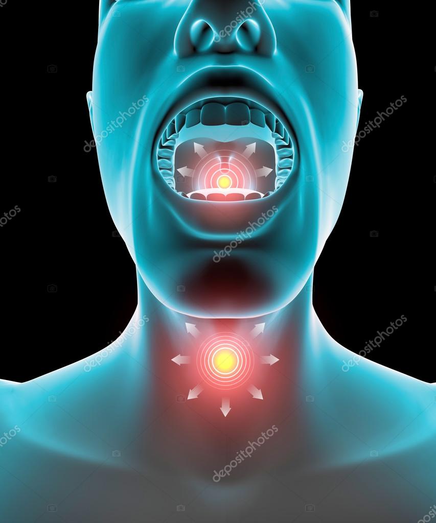 Sore throat inflammation, pain, redness — Stock Photo © vampy1 38245717