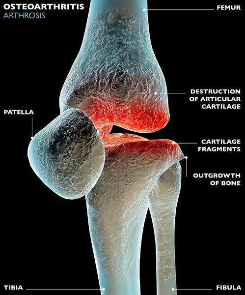 Beinknochen am Knie — Stockfoto