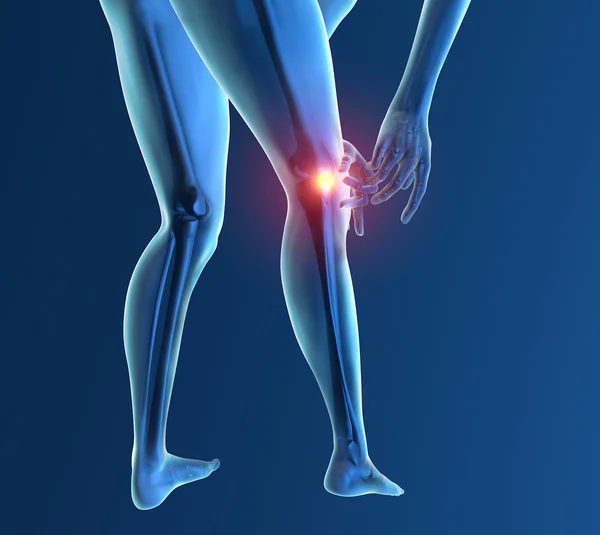 Zapalenie stawu kolanowego ból — Zdjęcie stockowe
