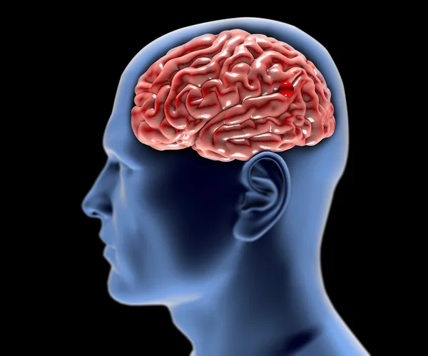Cerebral aneurysm, brain head — Stock Photo, Image