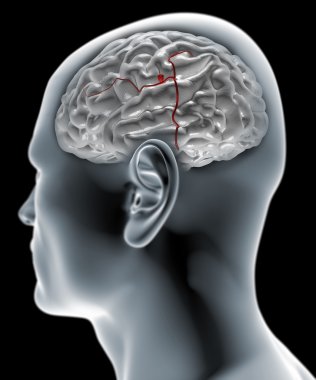 Cerebral aneurysm, brain head clipart