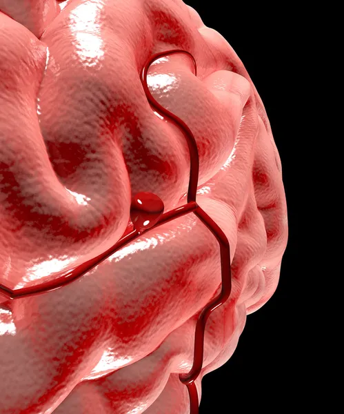 Cerebral aneurysm, hjärnan huvud — Stockfoto