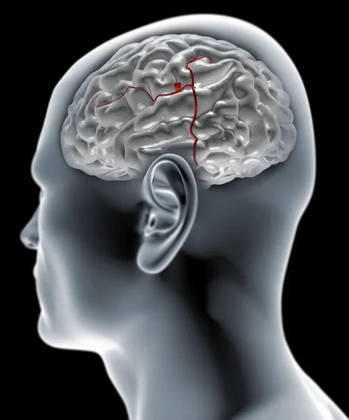 Mozkové aneurysma, mozku hlavu — Stock fotografie
