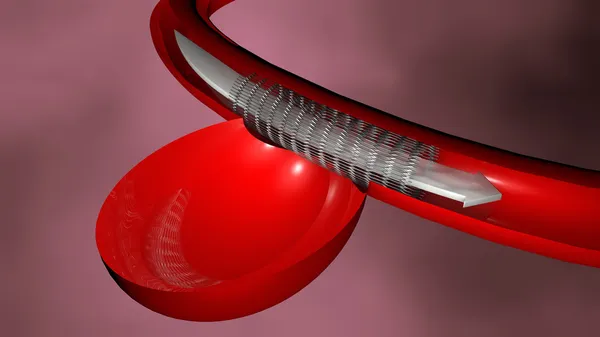 anevrizması, Endovasküler Tedavisi