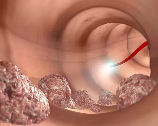 Colonoscopia del sistema digestivo — Foto de Stock