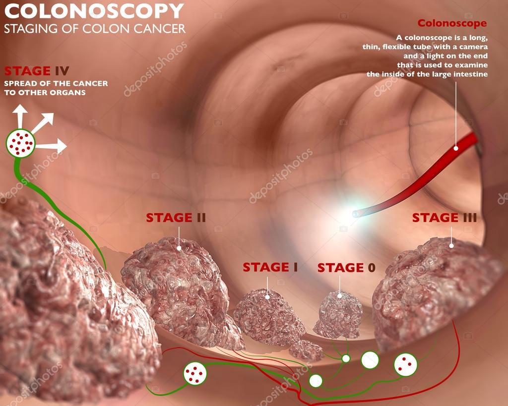 Colon Cancer Stage 4 dr-avais-chatha-i-center-for-digestive-disease-i-gastroenterology