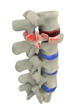 travmatik vertebra kırığı, patlama kırığı