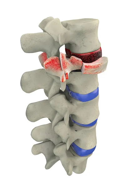 Traumatic vertebral fracture, burst fracture — Stock Photo, Image