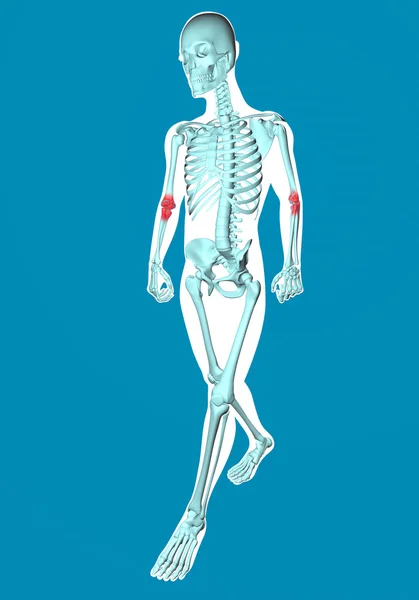 Radiografía de hombre caminante con dolor en los codos —  Fotos de Stock