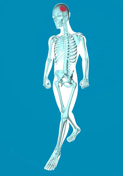 Homme marchant rayons X avec douleur dans le crâne — Photo