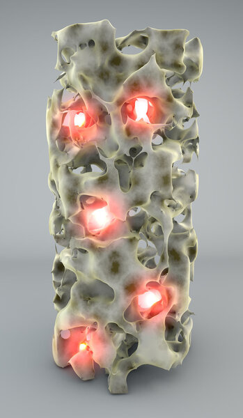 Section of bone with osteoporosis