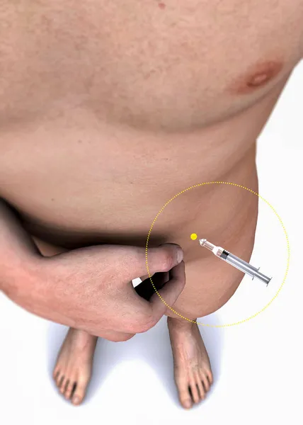 皮下注射肝素在腹部 裸胸和肝素注射器在腹部 防止血凝块 3D渲染 — 图库照片
