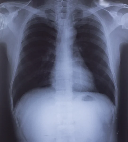 Image radiographique du thorax humain pour un diagnostic médical — Photo