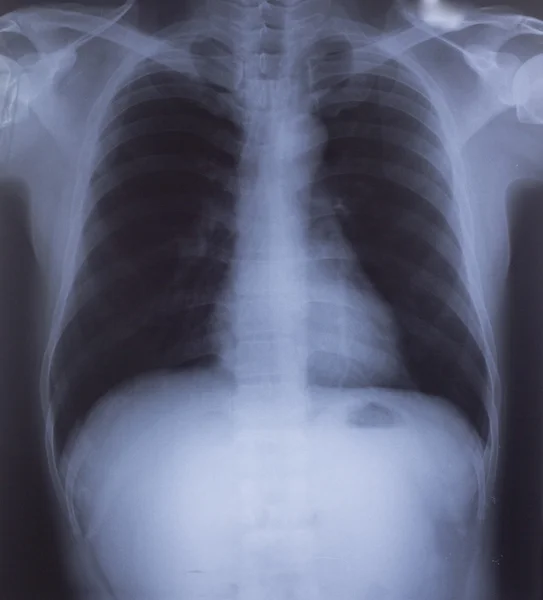 Röntgenbilden av mänskliga bröst för en medicinsk diagnos Royaltyfria Stockbilder