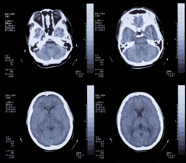 Gros plan d'un scanner avec cerveau Photos De Stock Libres De Droits