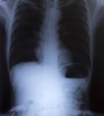 tıbbi tanı için insan göğüs x-ray görüntüsü