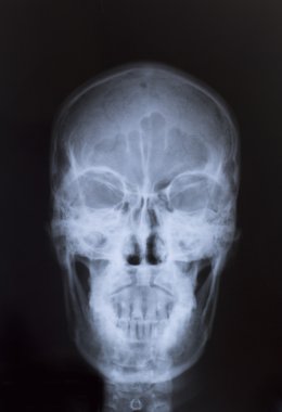 tıbbi tanı için insan göğüs x-ray görüntüsü