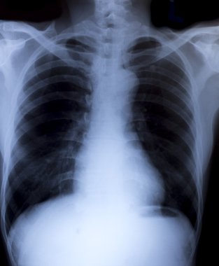 tıbbi tanı için insan göğüs x-ray görüntüsü