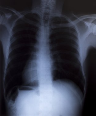 tıbbi tanı için insan göğüs x-ray görüntüsü
