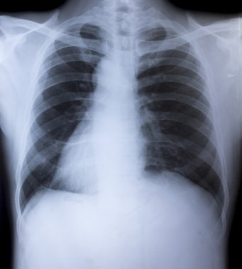 tıbbi tanı için insan göğüs x-ray görüntüsü