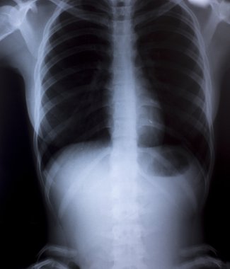 tıbbi tanı için insan göğüs x-ray görüntüsü