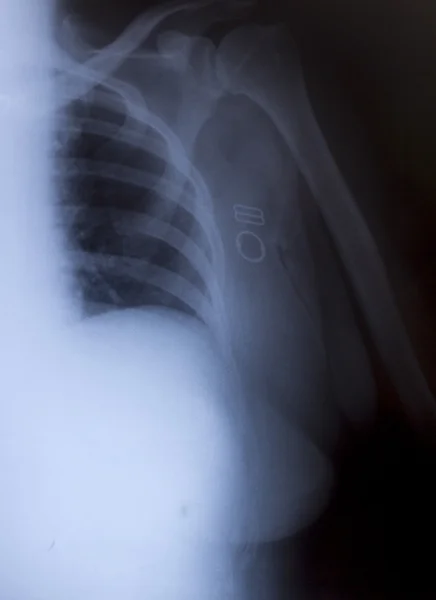 Рентгеновский снимок человеческой груди для диагностики — стоковое фото
