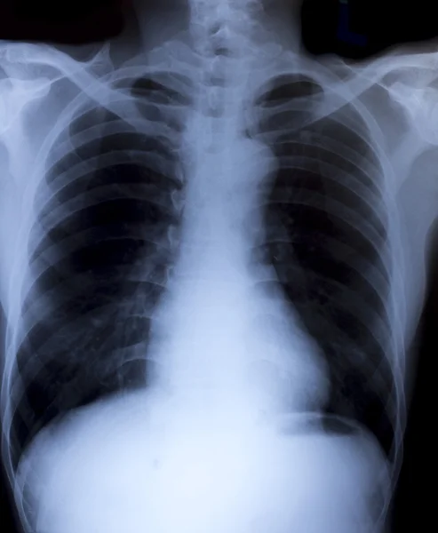 Εικόνα ακτινογραφία των ανθρώπινο στήθος για μια ιατρική διάγνωση — Φωτογραφία Αρχείου