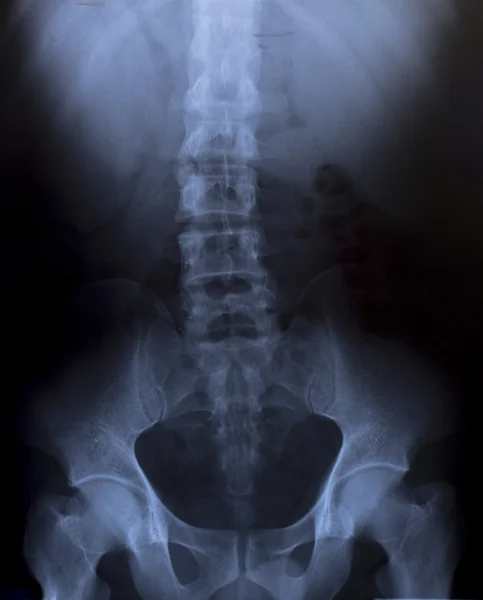 Рентгеновский снимок человеческой груди для диагностики — стоковое фото