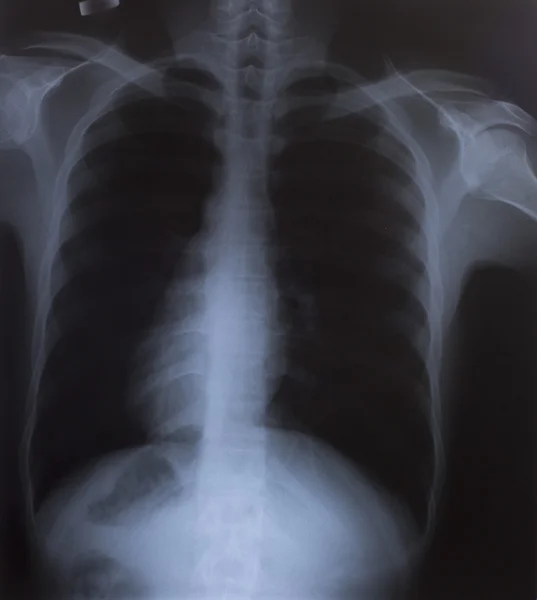 X-Ray kép az emberi mellkasi az orvosi diagnózis — Stock Fotó