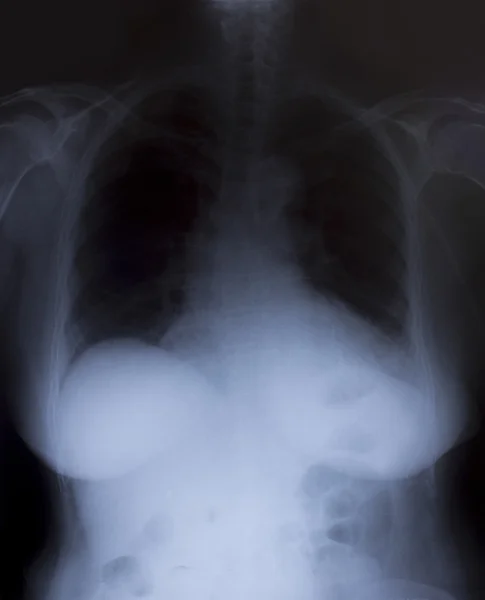 Image radiographique du thorax humain pour un diagnostic médical — Photo