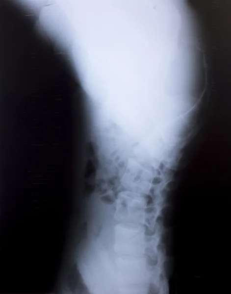 Zdjęcie rentgenowskie ludzkiej piersi do diagnostyki medycznej — Zdjęcie stockowe