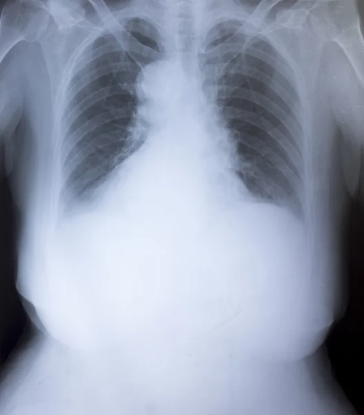 Rentgenový obraz lidského hrudníku pro lékařskou diagnostiku — Stock fotografie