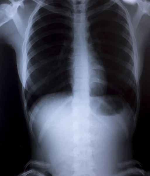 X-Ray Image Of Human Chest for a medical diagnosis — Stock Photo, Image
