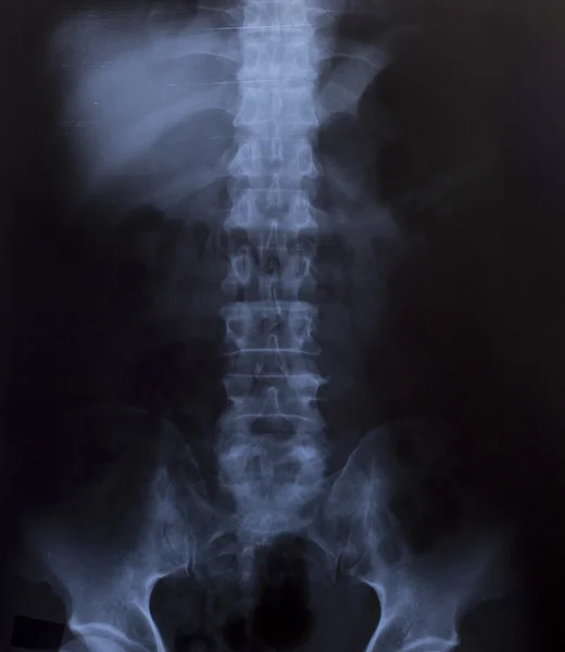 Röntgenbild der menschlichen Brust für eine medizinische Diagnose Stockbild