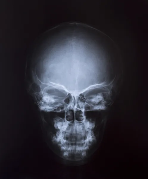 Imagen de Rayos X del Pecho Humano para un diagnóstico médico Fotos de stock libres de derechos