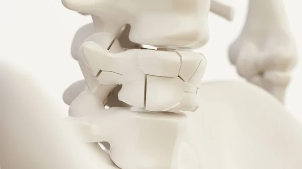 Fractura Vertebral Debida Osteoporosis Columna Vertebral Renderización —  Fotos de Stock