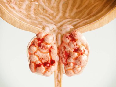 Prostat Kanseri Evresi 04 - Detaylı Yüksek Kalite 3D Yapılandırma