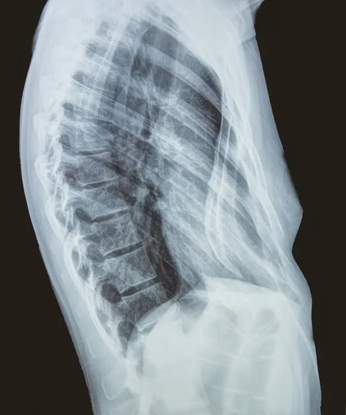 Lateral x-ray of the torso of a woman — Stock Photo, Image