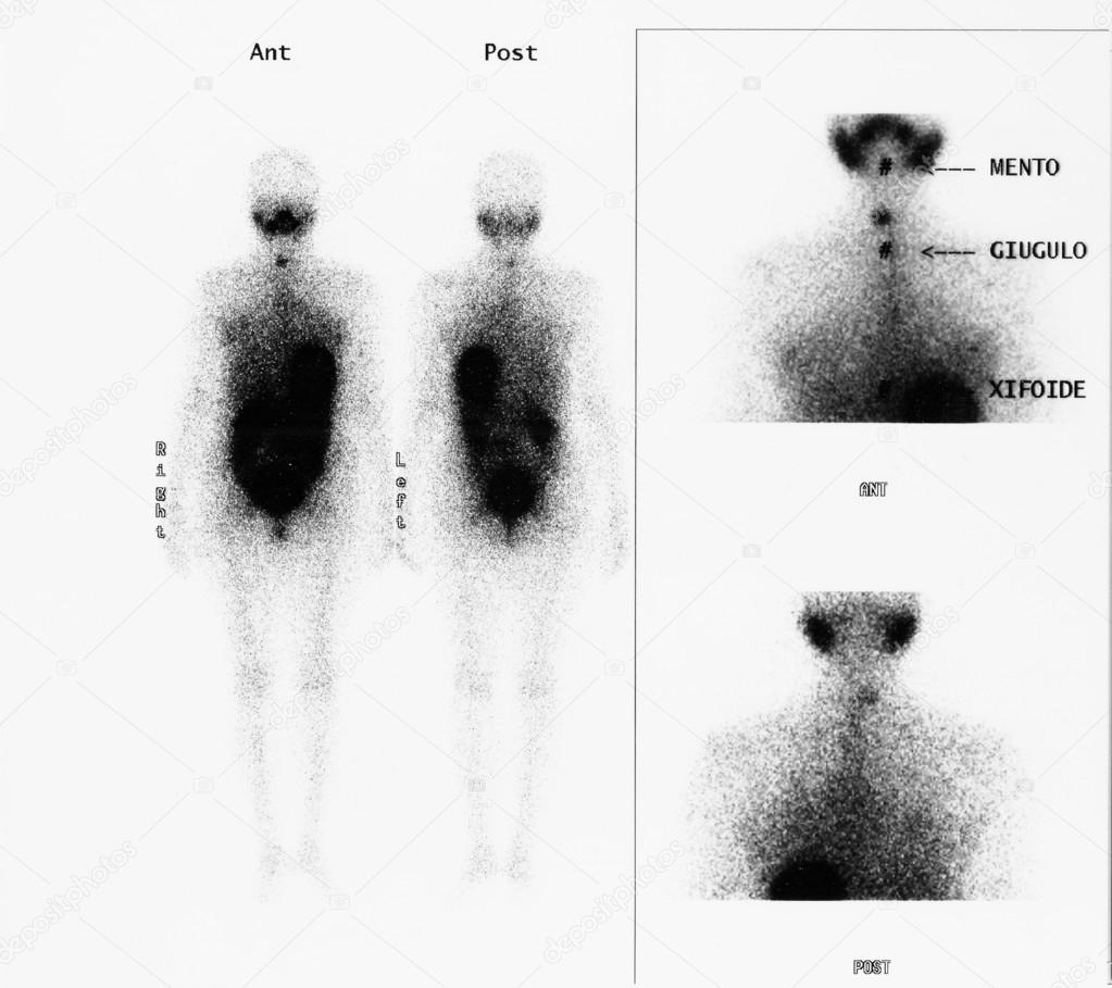 Scintigraphy